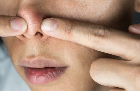 Are you at Loggerheads with your Blackheads?