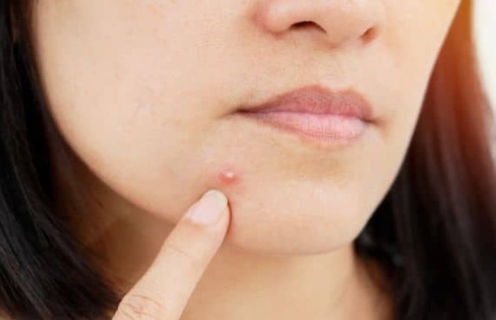 Adult Acne - Causes & Treatment