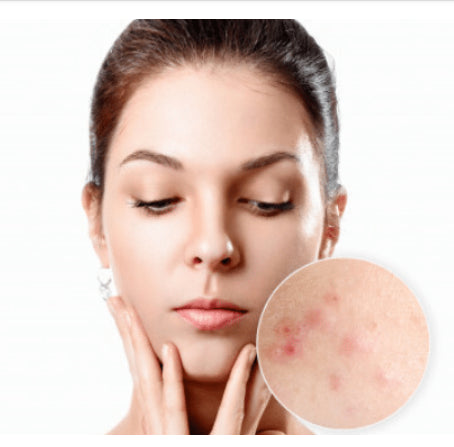 How to Get Rid of Pimples Overnight DIY & Other FAQs on Pimples